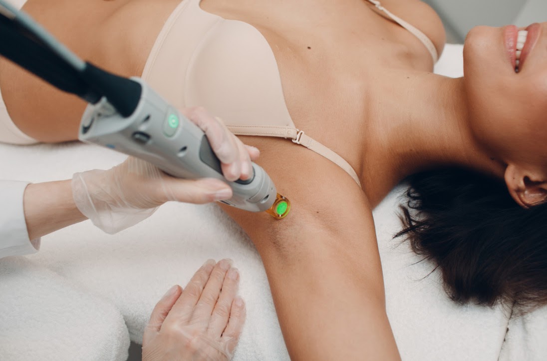Trị thâm nách bằng công nghệ LASER thế hệ mới nhất 2021 tại K Beauty Spa giúp xóa thâm vĩnh viễn 