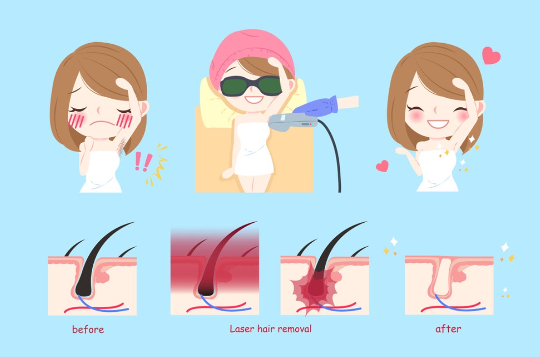 Hiệu quả điều trị thâm nách triệt để, toàn diện bằng công nghệ laser